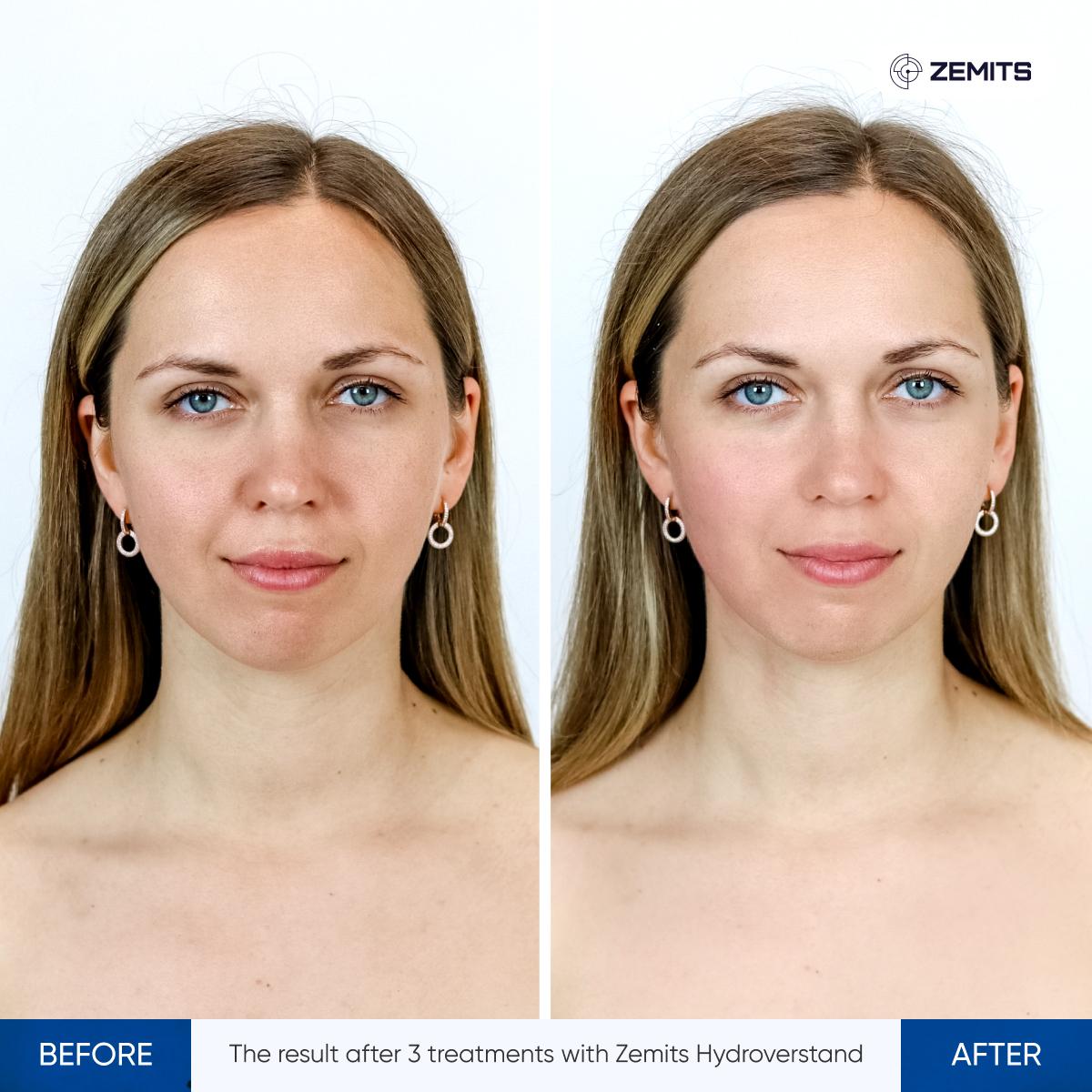 HydroVerstand Pro Facial before and after