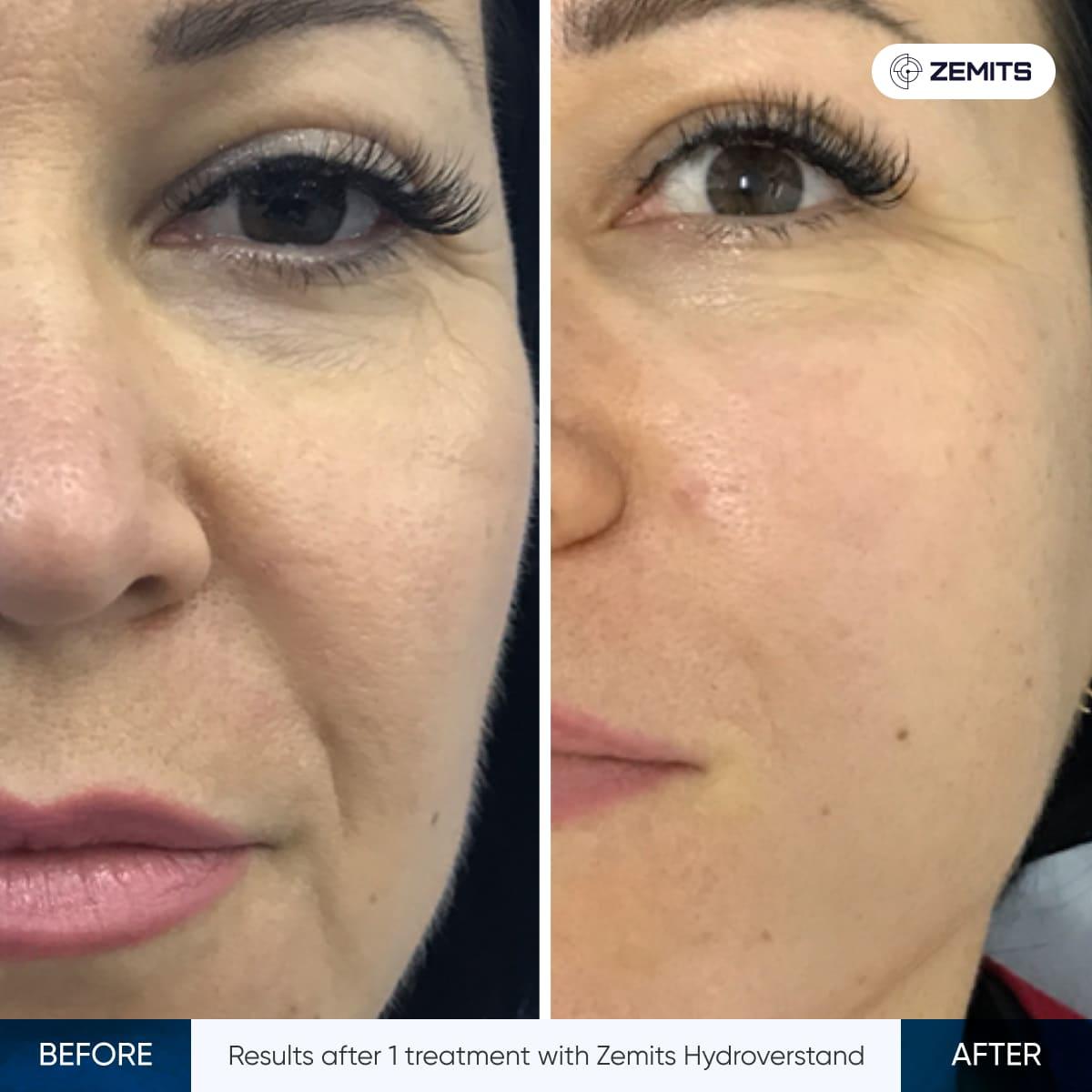 HydroVerstand Pro Facial before and after