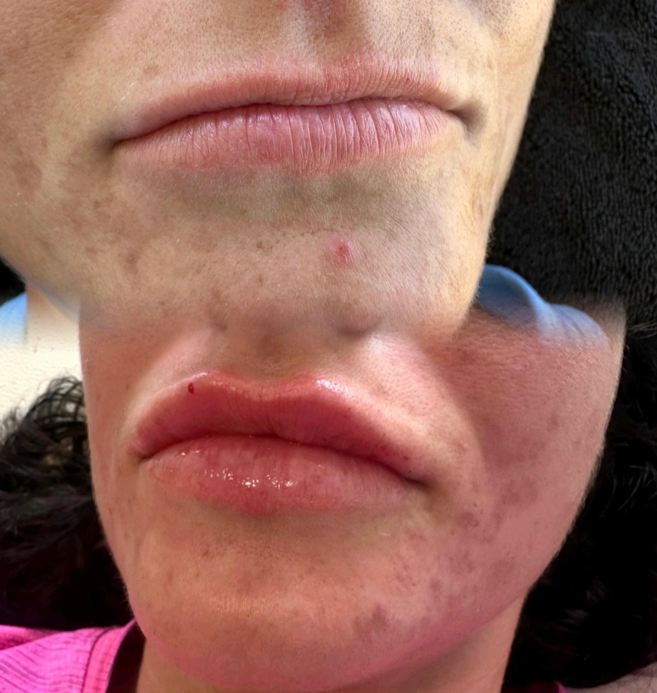 Lip Fillers before and after