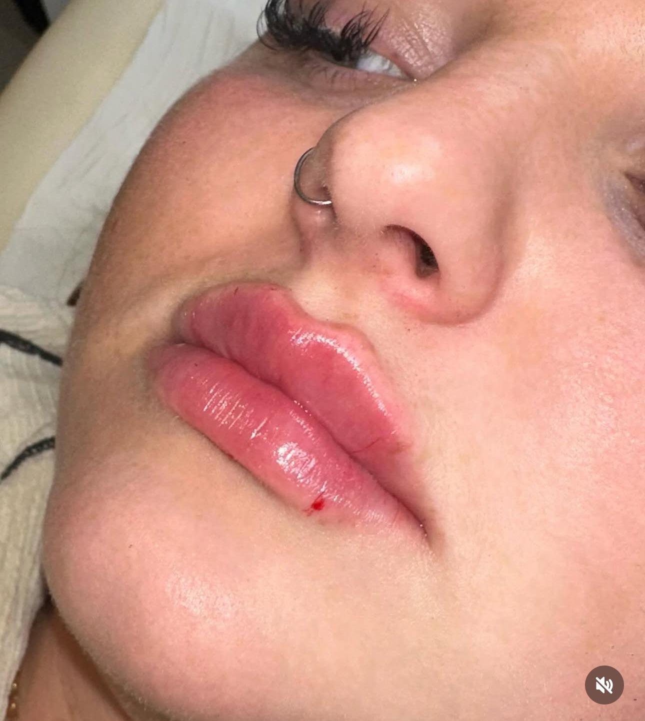 Lip filler treatment example