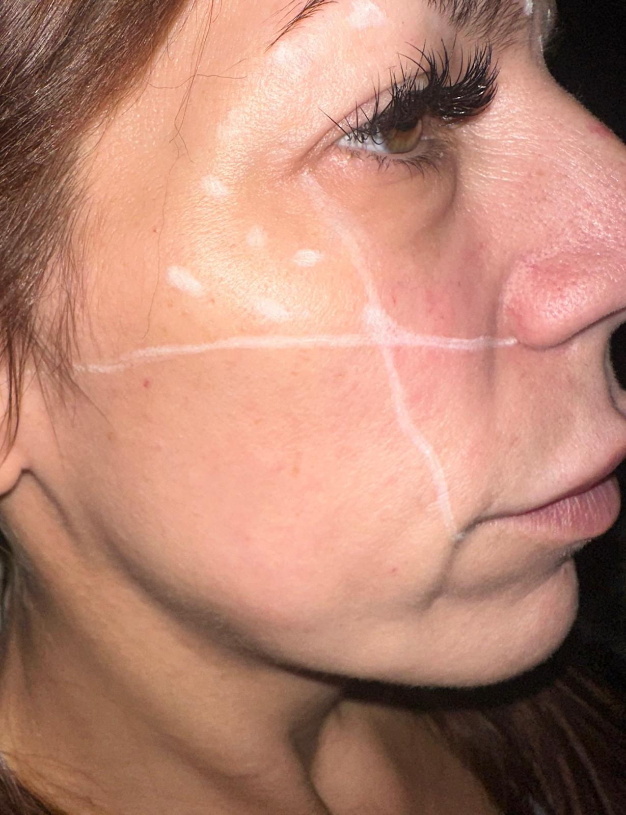 Liquid Facelift before