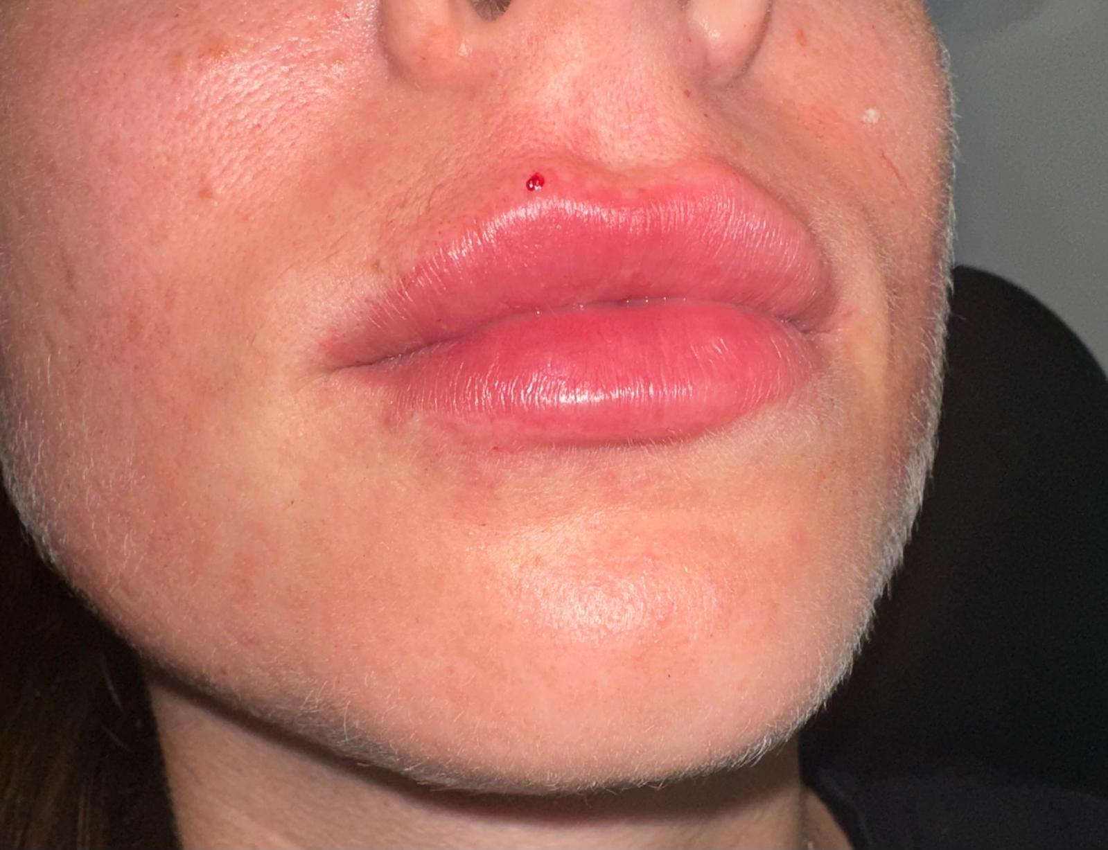 Lip Filler after