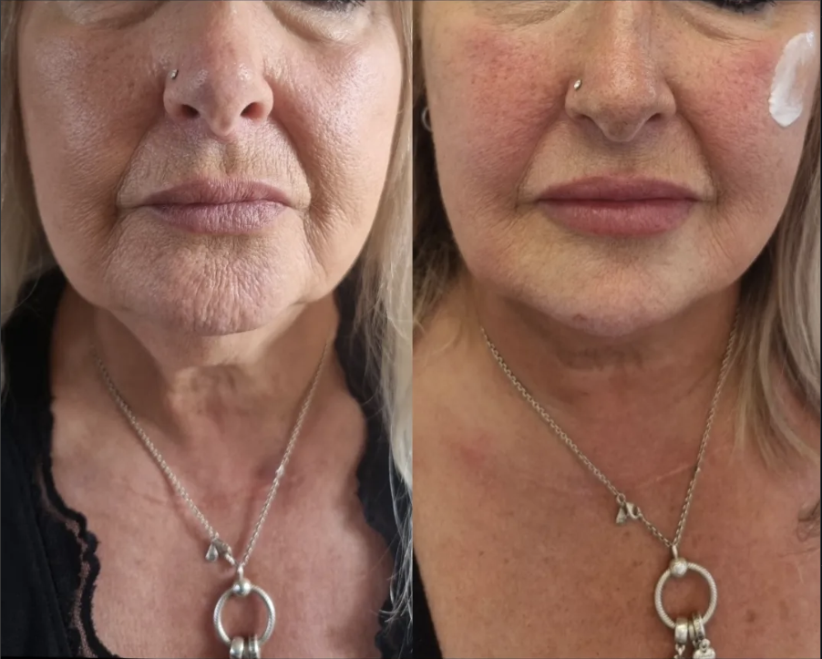 Dermal Fillers before and after