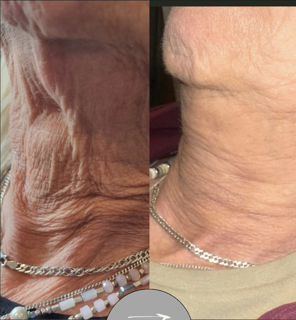 Skin Boosters before and after