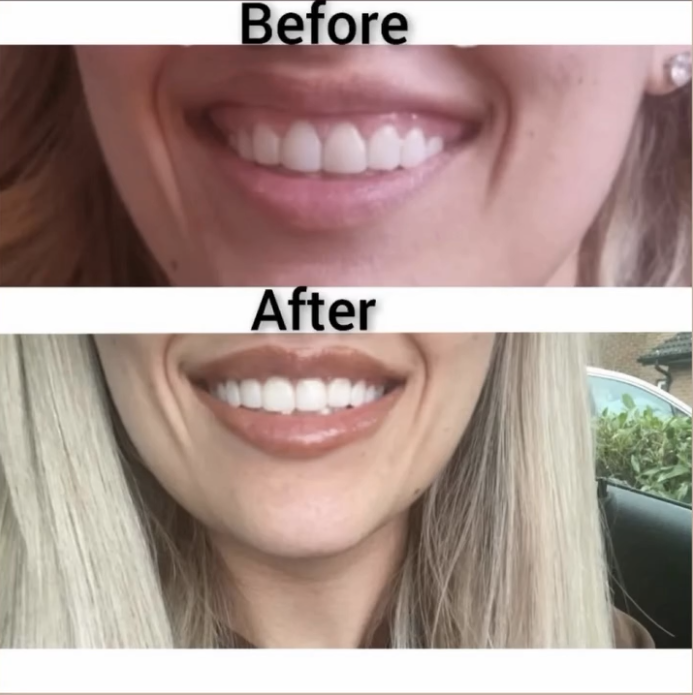 Gummy Smile before and after