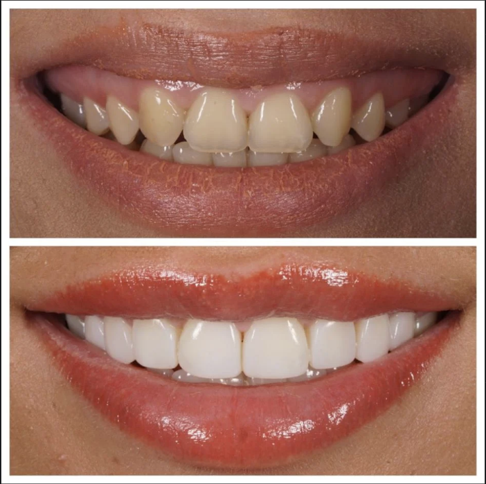 Lip Fillers before and after
