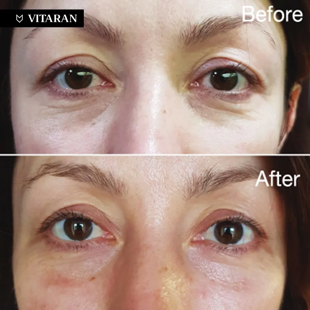 Polynucleotide aesthetic treatment at SOS Aesthetics clinic — SOS Aesthetics