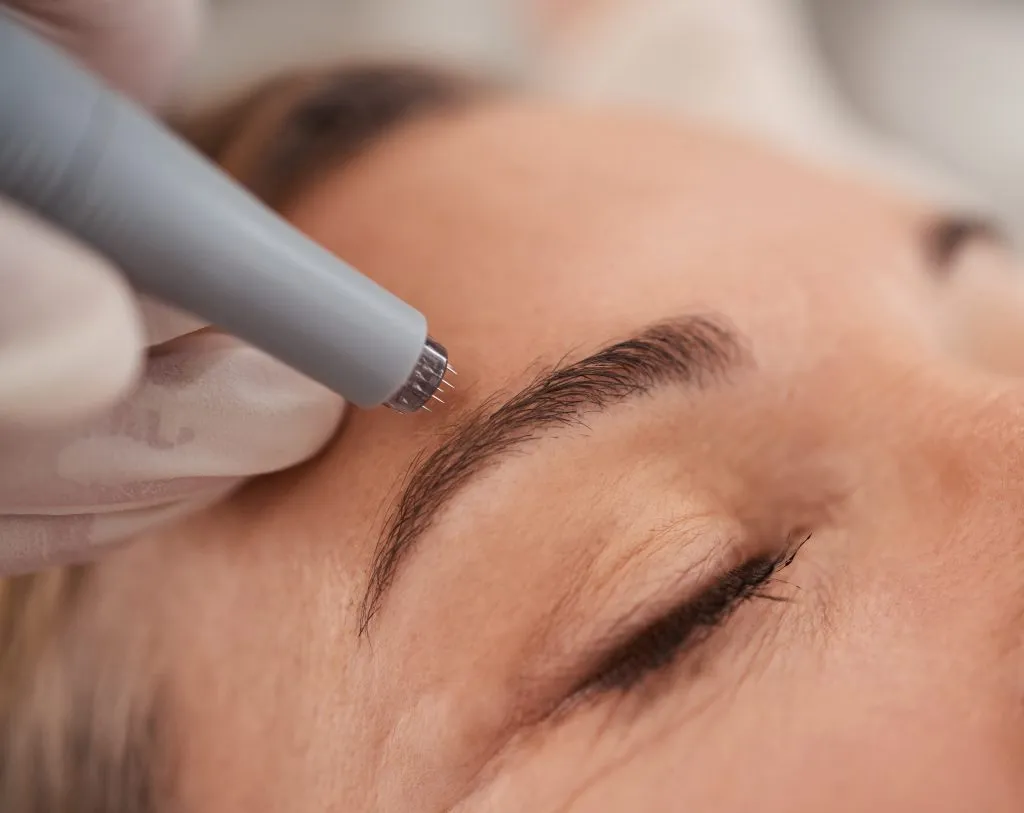 Microneedling treatment